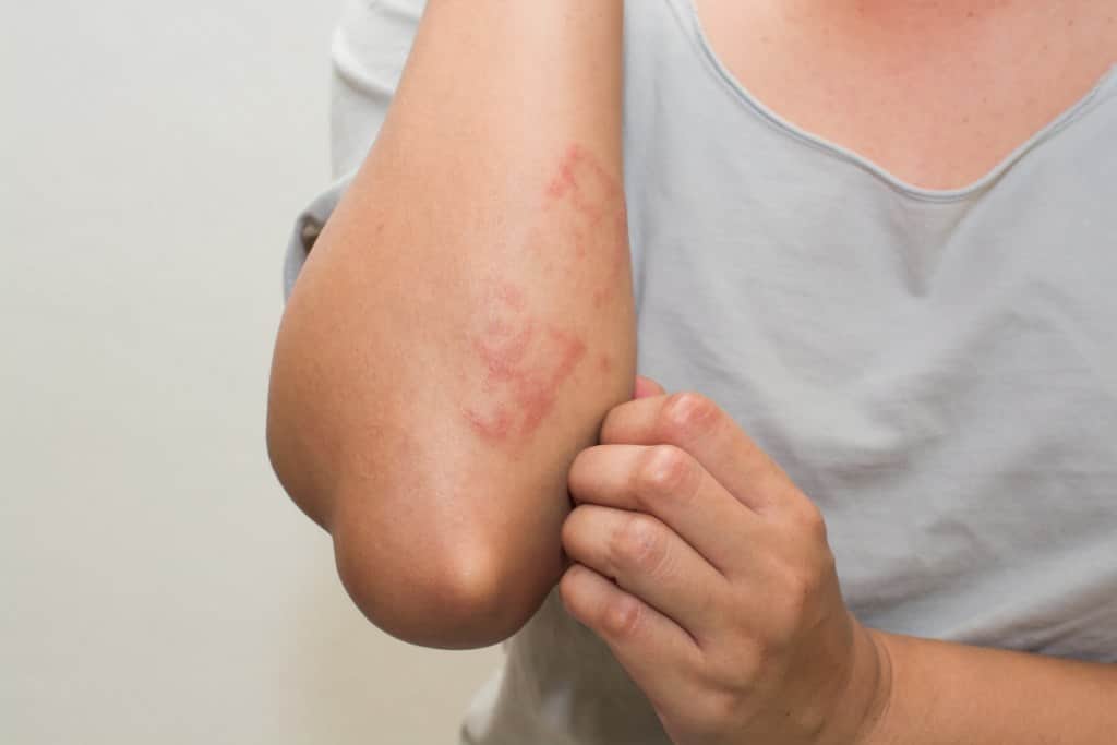 Dermatitis atópica: las dificultades para sostener la atención y el tratamiento