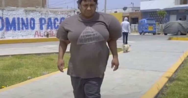 El dramático caso de Alejandro Ramos, el buzo peruano que lleva años «inflado» por un accidente