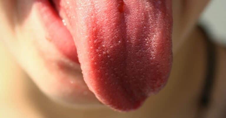 ¿Manchas en la lengua? Descubre qué es la lengua geográfica y cómo tratarla