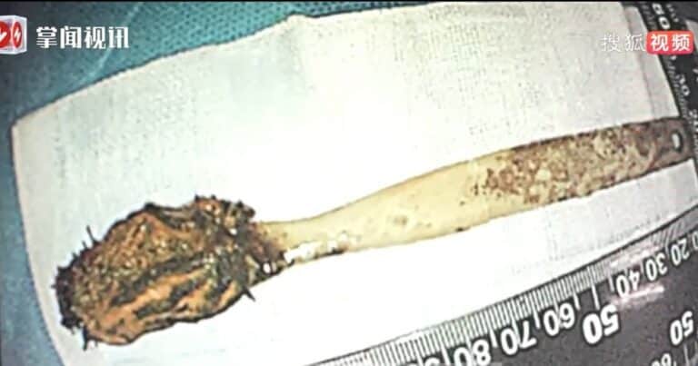 Fue al hospital por un dolor abdominal y quedó impactado: tenía un cepillo de dientes atrapado en su cuerpo desde hace 50 años
