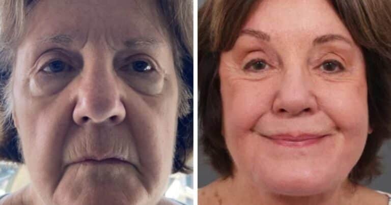 Una mujer de 78 años mostró imágenes de su rejuvenecimiento facial y captó la atención de miles de personas