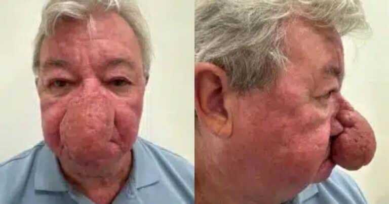 Por una extraña condición, su nariz se agrandó y cubrió su boca: «Era difícil besar a mi esposa»