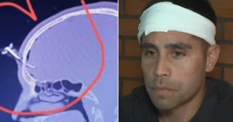 Habló el jugador del Ascenso que le clavaron una llave en la cabeza: «No sabían si podían salvarme, por suerte lo puedo contar»