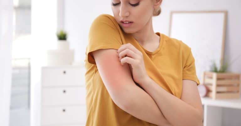 Acné, rosácea y dermatitis: qué cosas de la comida empeoran tu piel y cómo cuidar la microbiota