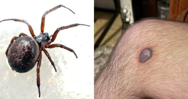 Un joven sobrevivió a la mordedura de una falsa viuda negra, una peligrosa araña venenosa