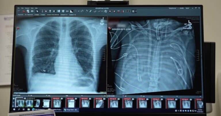 El hombre que vivió 48 horas sin pulmones