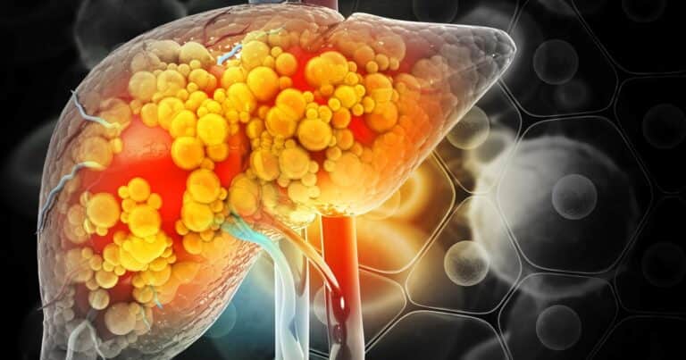 Parece saludable pero puede dañar el hígado: la bebida que los hepatólogos miran con desconfianza