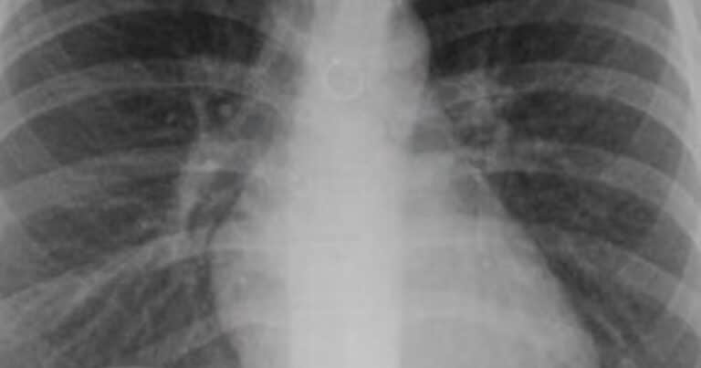 Empezó a toser y un mes después descubrió que tenía un piercing nasal en uno de sus pulmones: «Los médicos estaban impactados»
