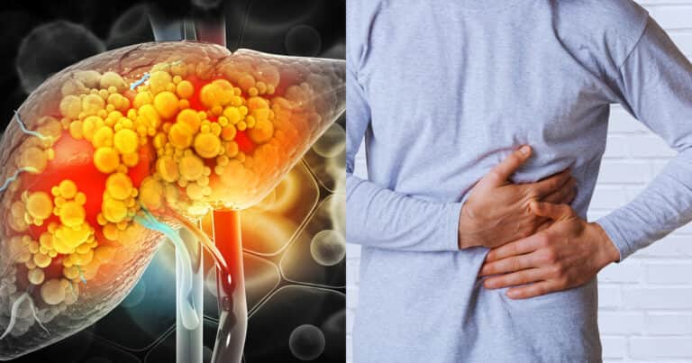 Hígado graso: los factores que complican su recuperación y afectan la salud