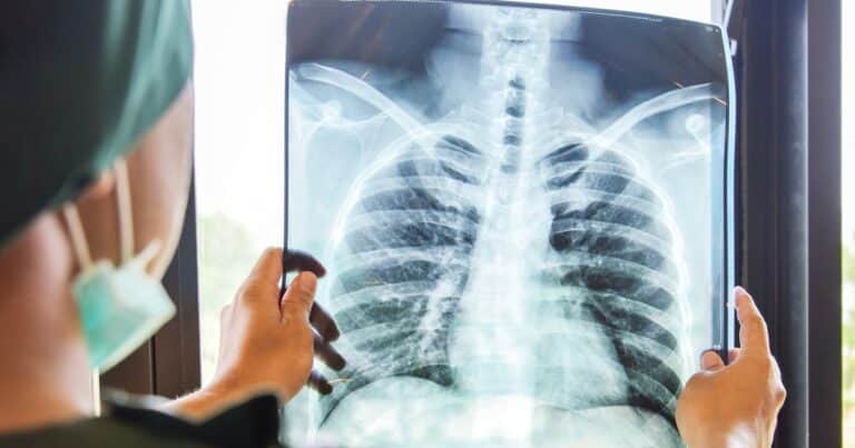 Un análisis de sangre puede detectar el riesgo de cáncer de pulmón cinco años antes del diagnóstico, según un estudio