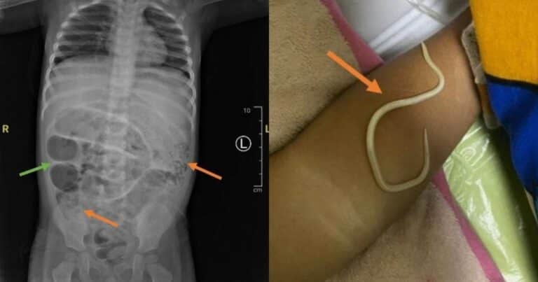 Le dolía mucho la panza, fue al médico y descubrieron gusanos en su intestino