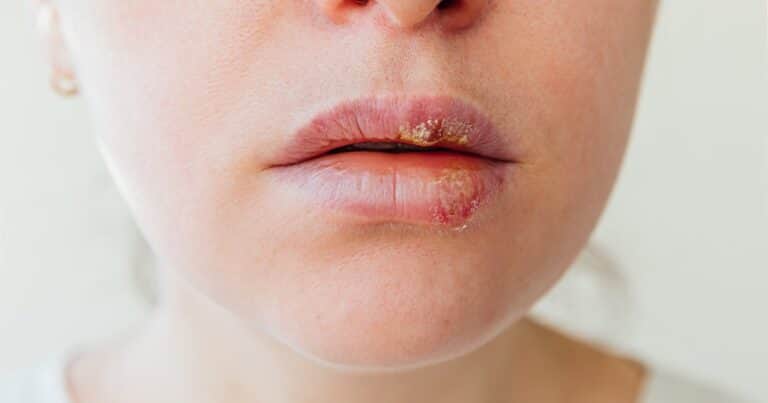Cómo combatir el herpes labial: consejos y tratamientos efectivos