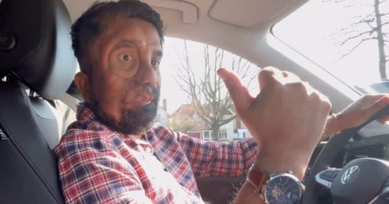 La historia de Amit Ghose: sufrió acoso por el aspecto de su cara y ahora inspira a los demás