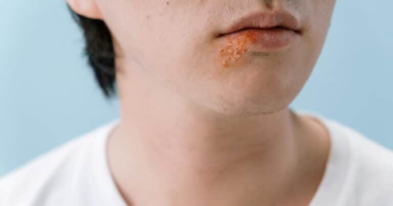 Alzheimer y herpes labial: la conexión que revela la ciencia