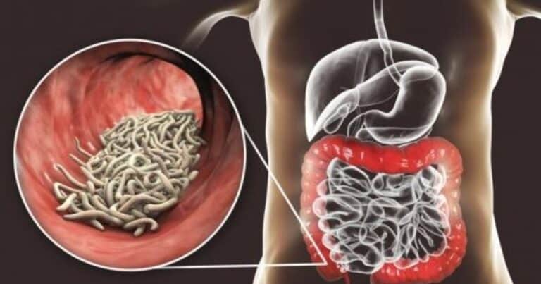 Síntomas de los parásitos intestinales: señales que no podés ignorar