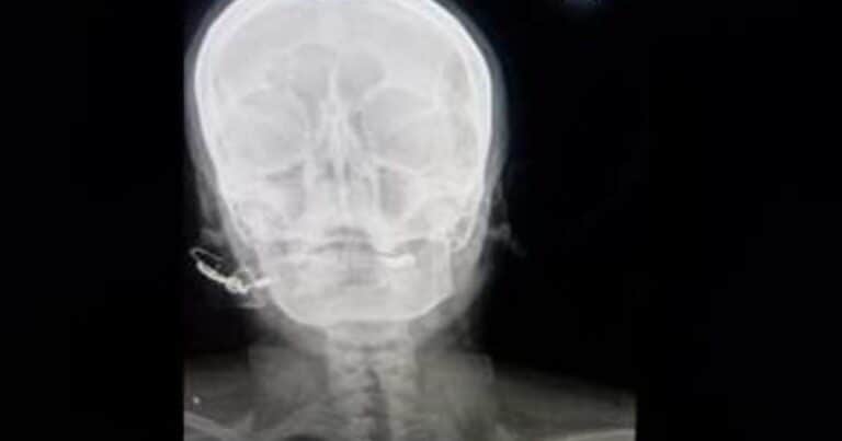 Para que «tuviera un varón», un curandero le clavó un clavo en la cabeza a una embarazada
