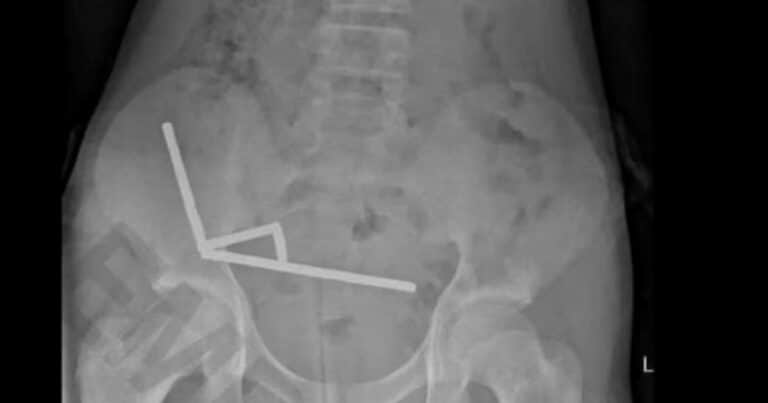 Un adolescente se tragó casi 200 imanes que compró por internet y perdió parte de su intestino