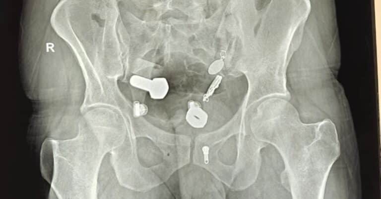 Fue al hospital por un fuerte dolor de panza y los médicos descubrieron un reloj, tuercas y tornillos en su cuerpo