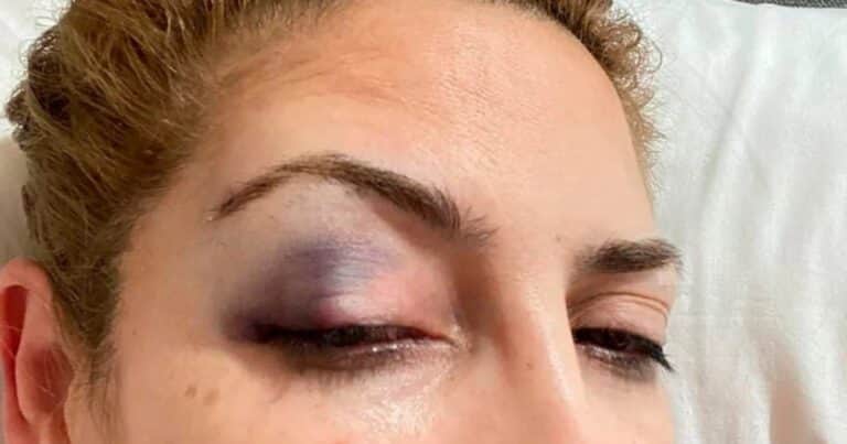 «Ese ojo morado existió»: Fabiola Yañez dio detalles de uno de los hechos de violencia por los que denunció a Alberto Fernández