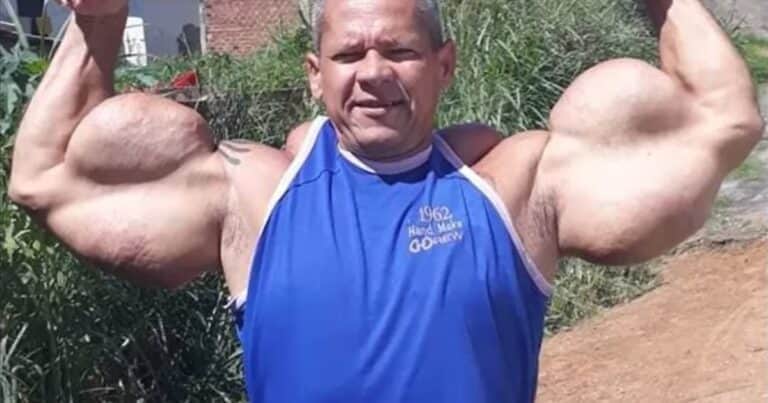 A los 55, murió el “Popeye brasileño”, el hombre que se inyectó aceite en los brazos durante tres décadas para tener bíceps extremos