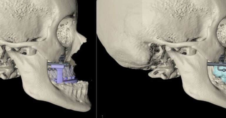 Científicos descubrieron una operación quirúrgica maxilofacial de hace 2.500 años