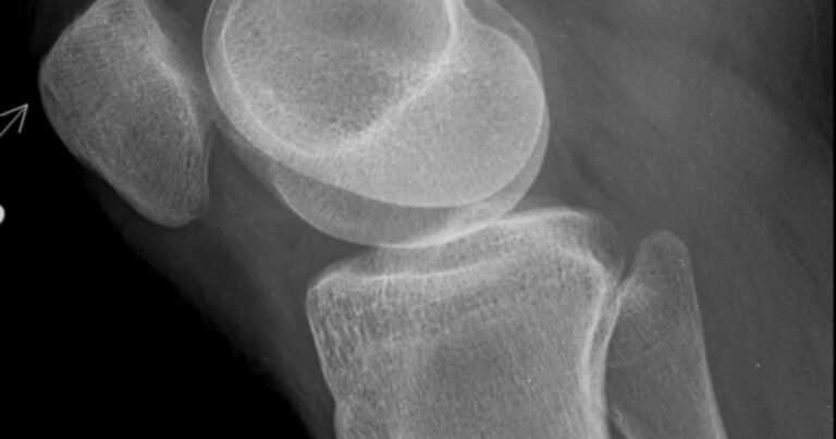 Alternativas para tratar la artrosis de rodilla