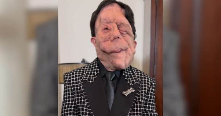 Qué es la neurofibromatosis, la enfermedad que el actor Adam Pearson visibilizó en los Premios Oscar