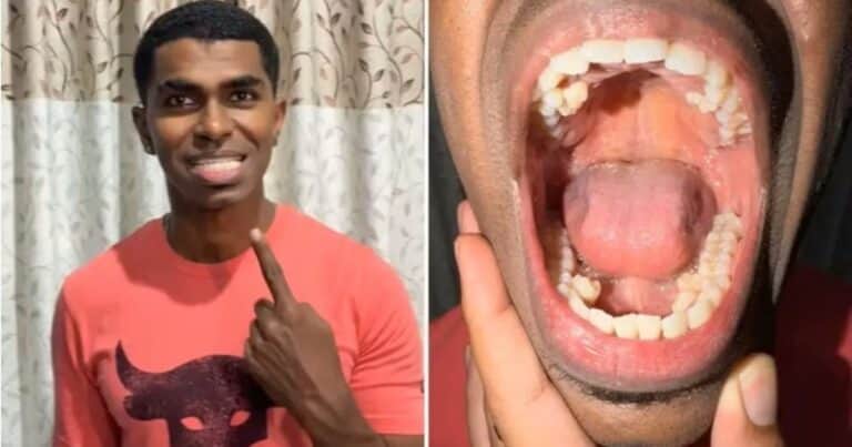 El hombre cuya boca asombra al mundo: tiene 42 dientes