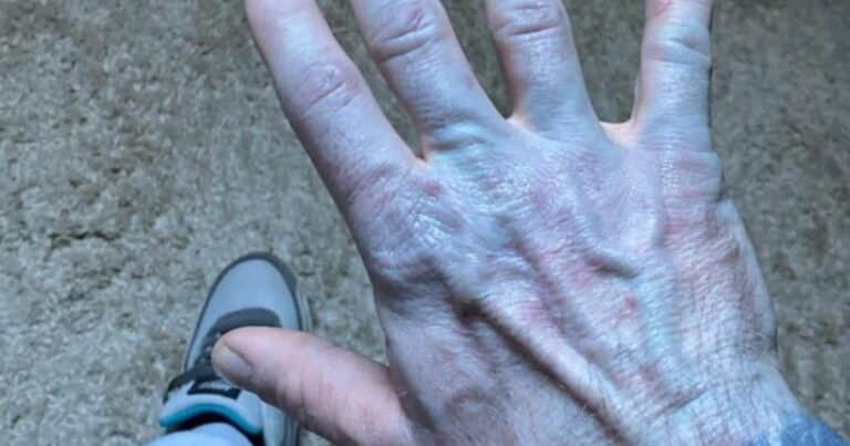 Se despertó con la piel azul y en el hospital descubrió la inesperada causa: «Me sentí avergonzado»