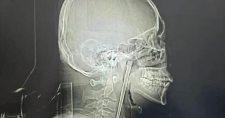 Un hombre vivió 8 años con un palillo de metal atascado en la garganta