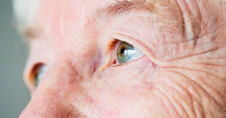 Colesterol alto: las señales que pueden verse en los ojos