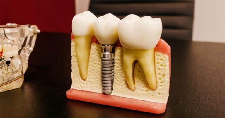 Implantes dentales: el riesgo que preocupa cada vez más y por qué no siempre convienen
