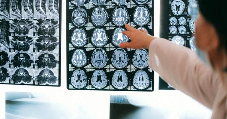 Investigadores españoles crean un parche de seda para reparar el cerebro después de un ictus: “Muestra un alto potencial para el tratamiento del ictus y otras lesiones cerebrales agudas”