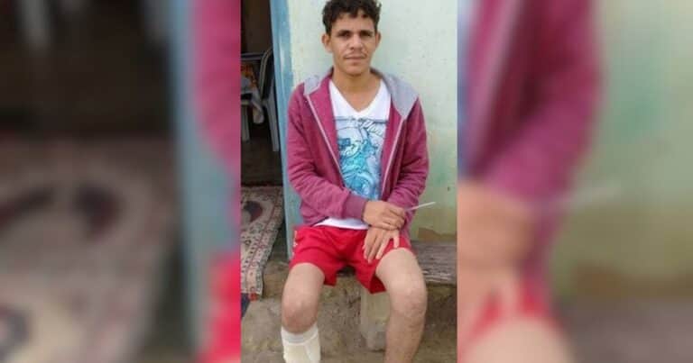 Un funcionario reclamó una indemnización de US$ 291.200 por perder una pierna, pero descubrieron que se había mutilado a propósito