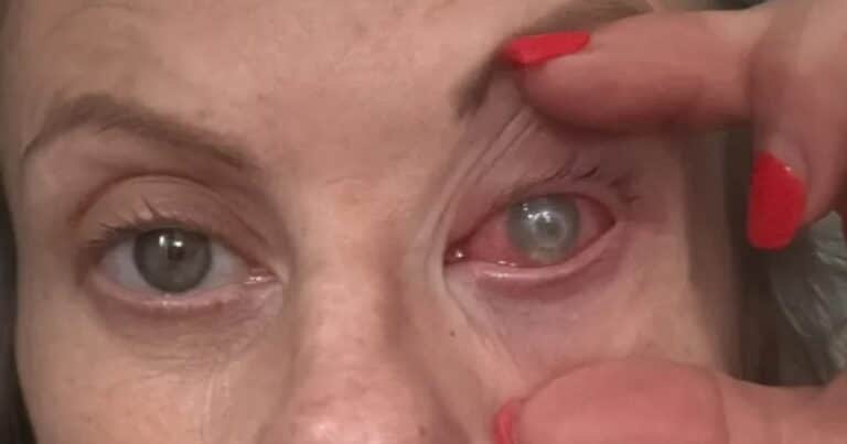 Una mujer podría perder la visión por una rara infección ocular: «Se va comiendo el ojo, la córnea y todos los nervios»