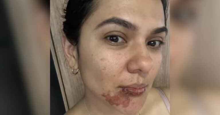 Sufrió un imprevisto con una empanada y su historia llegó a millones: «Explotó en mi cara»