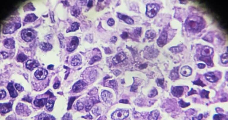 Osteosarcoma: tasas de supervivencia y factores que influyen en el pronóstico