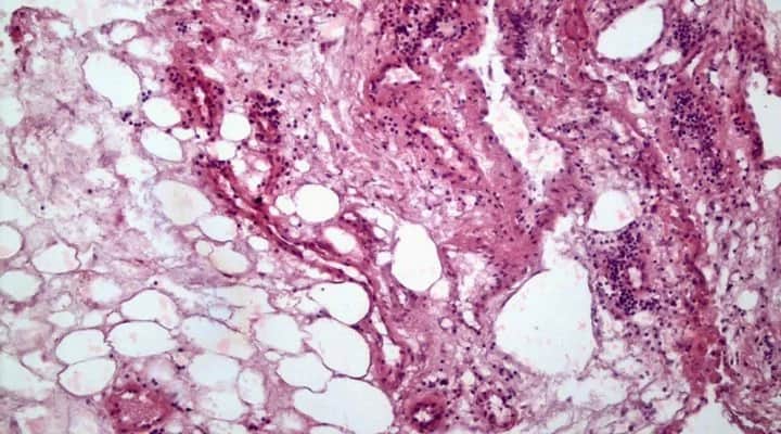 Un estudio del Conicet analizó el impacto del cáncer renal en el tejido adiposo